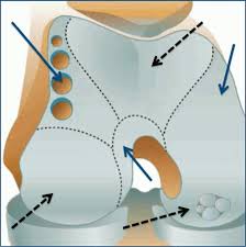 Cartilage Restoration Specialist In Jaipur | Cartilage Restoration Clinic | Cartilage Restoration