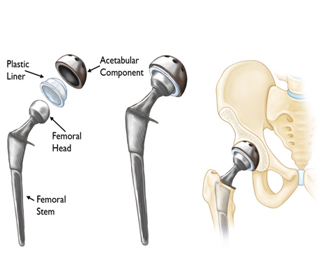 Consult to Dr. Rajat Jangir, Best Hip Replacement Doctor In Jaipur, has vast
knowledge in Hip Replacement surgeries