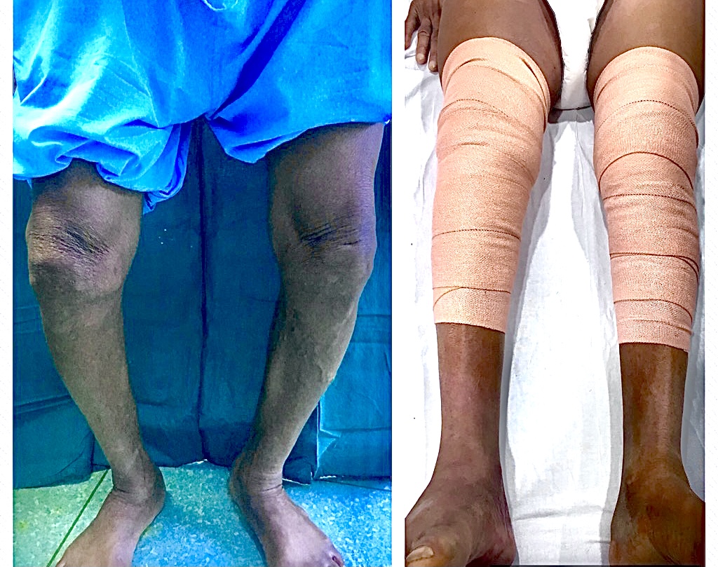 Knee Replacement in jaipur
